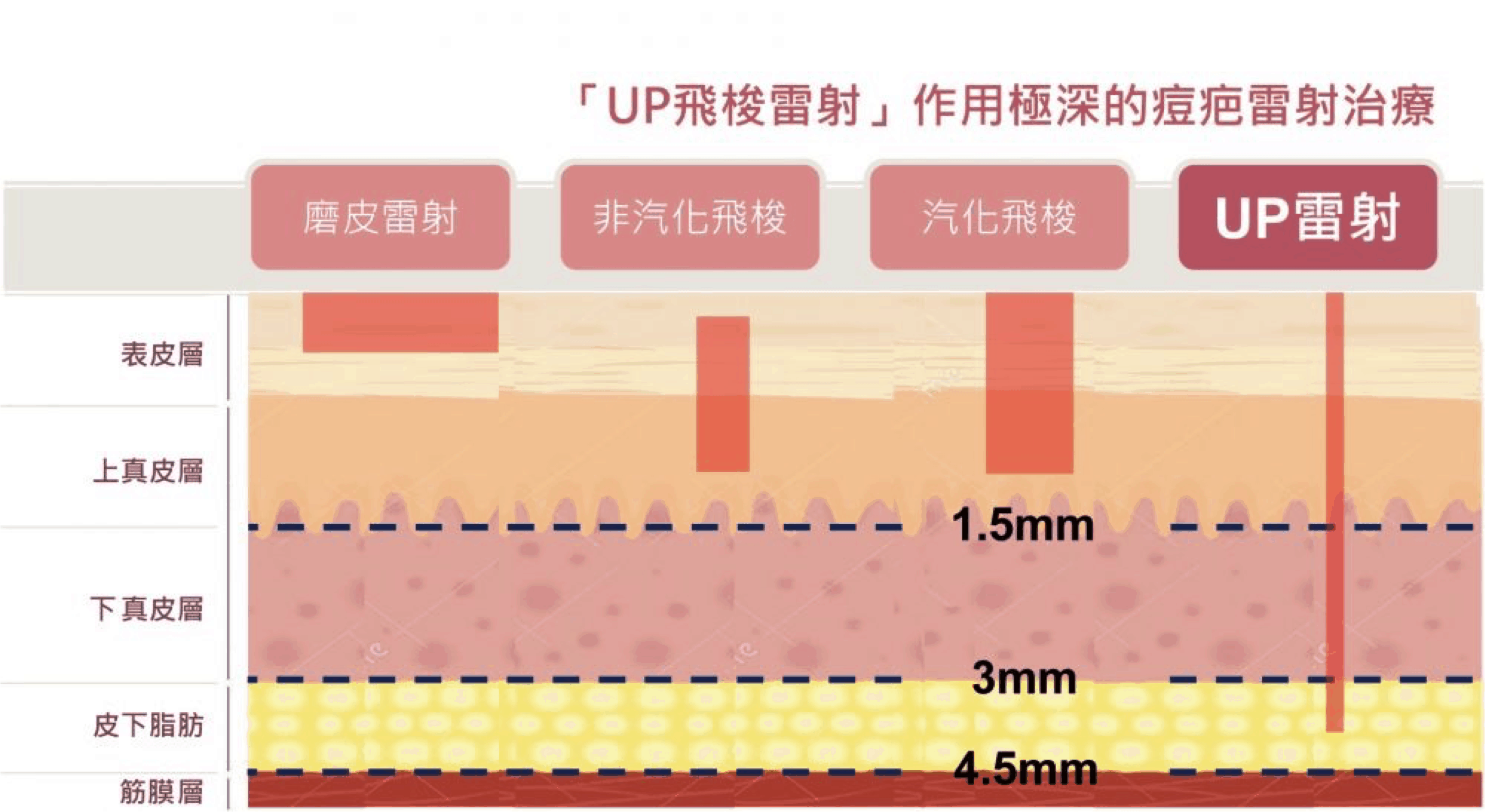 UltraPulse UP雷射 4
