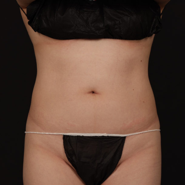 coolsculpting after front