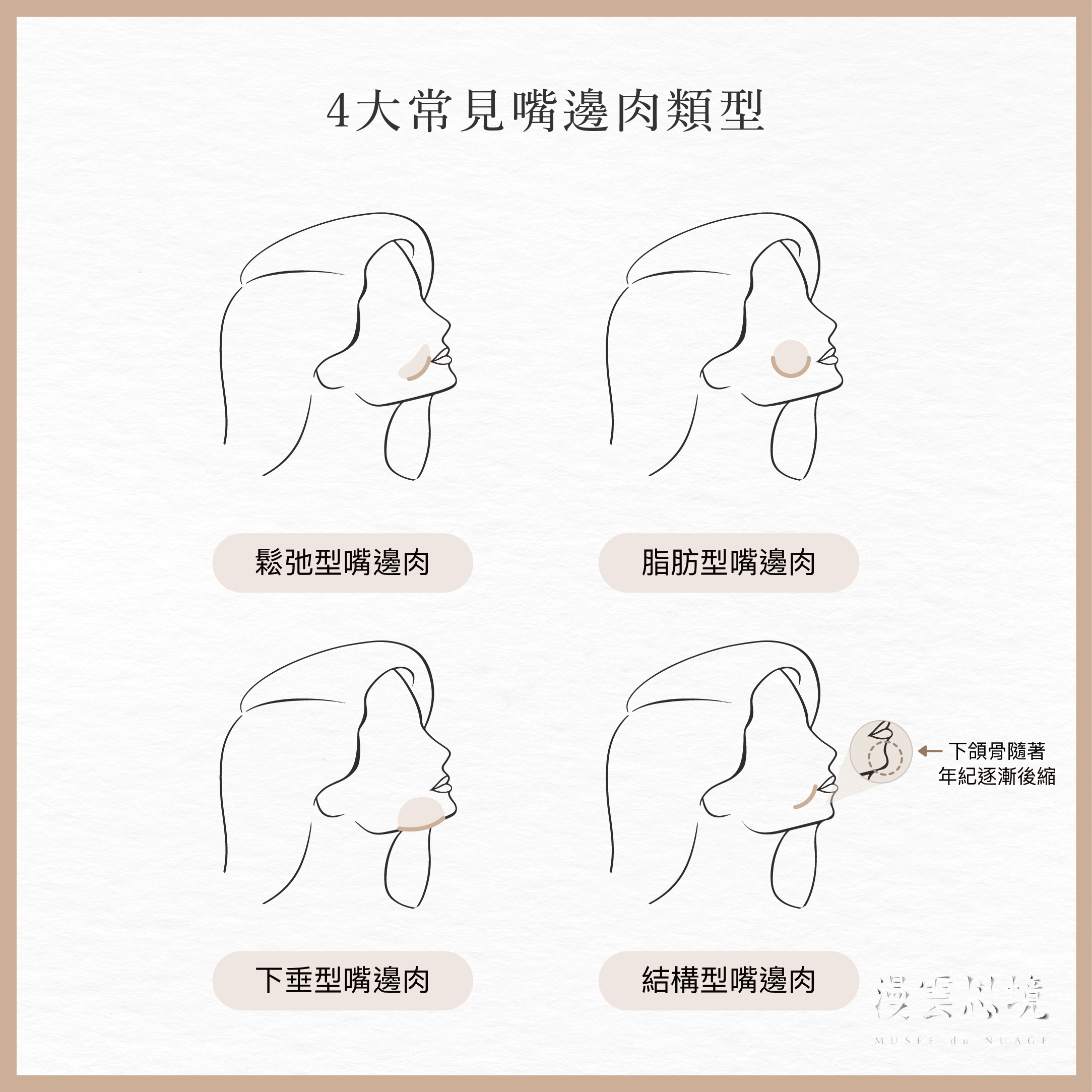 4種常見嘴邊肉類型