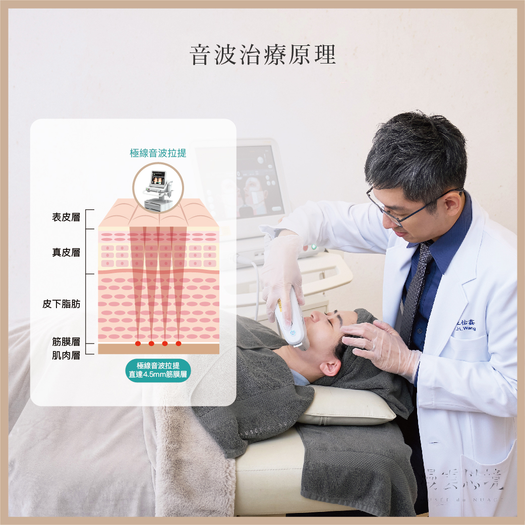 消除嘴邊肉醫美療程1：音波拉提