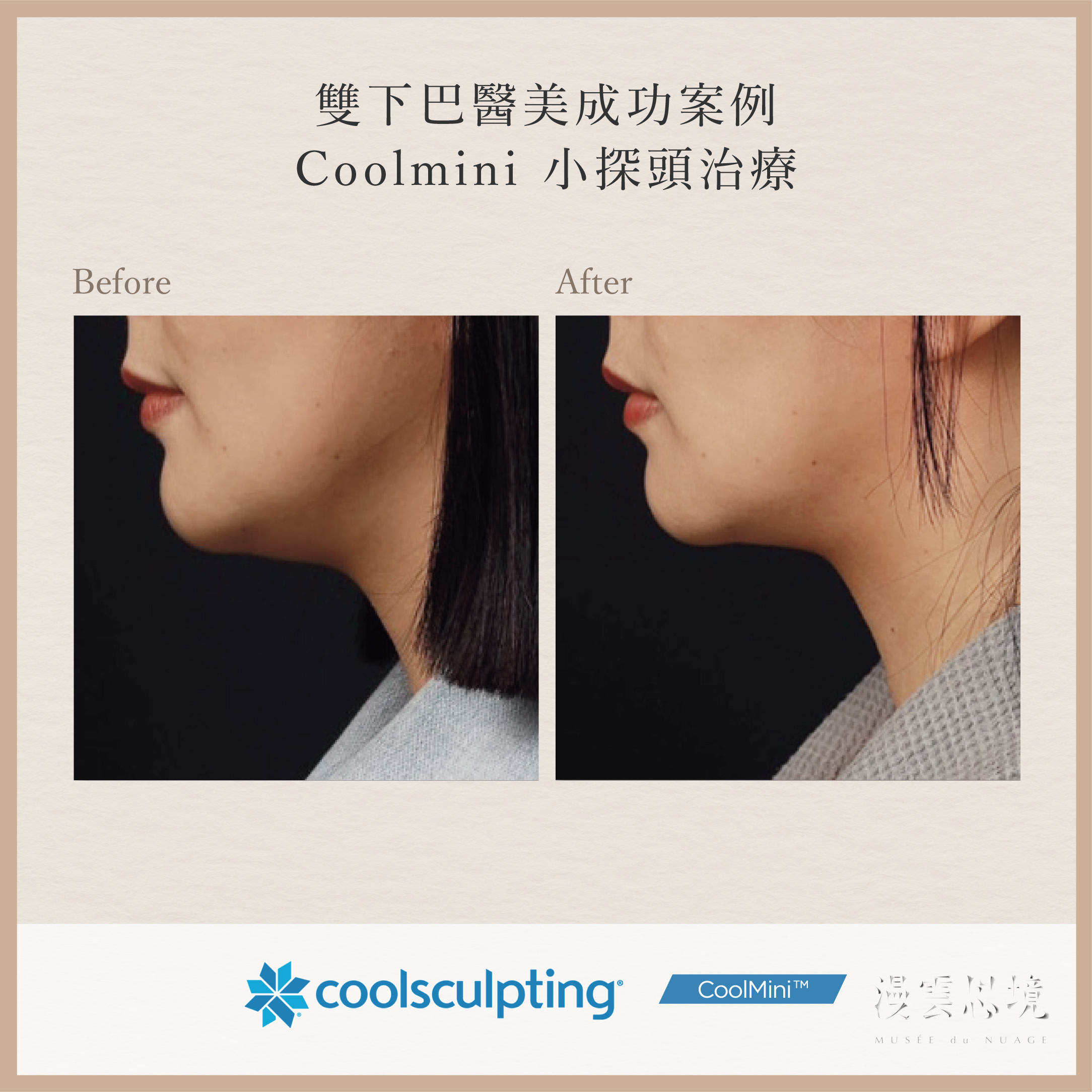 雙下巴醫美成功案例：Coolmini小探頭治療