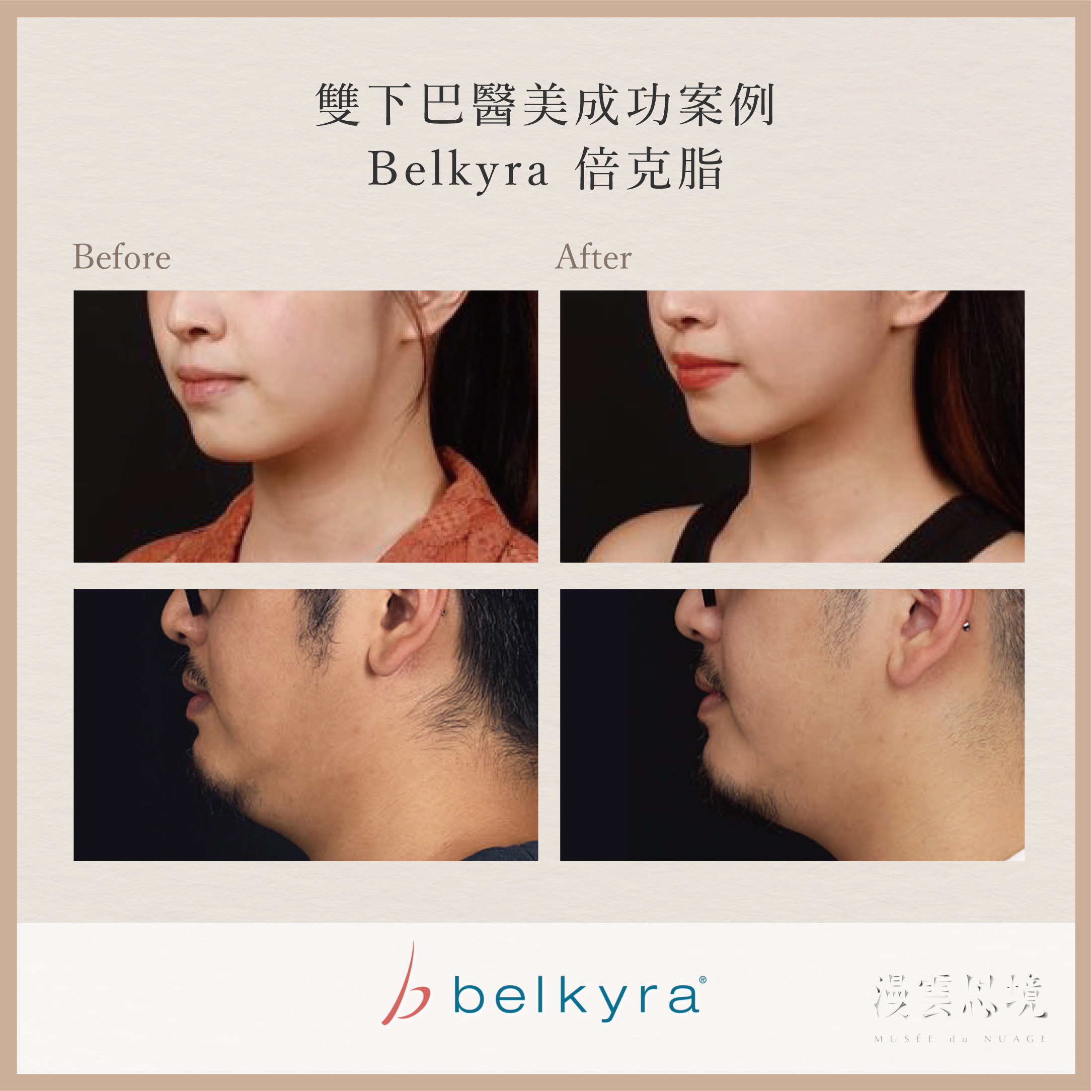 雙下巴醫美成功案例：Belkyra倍克脂