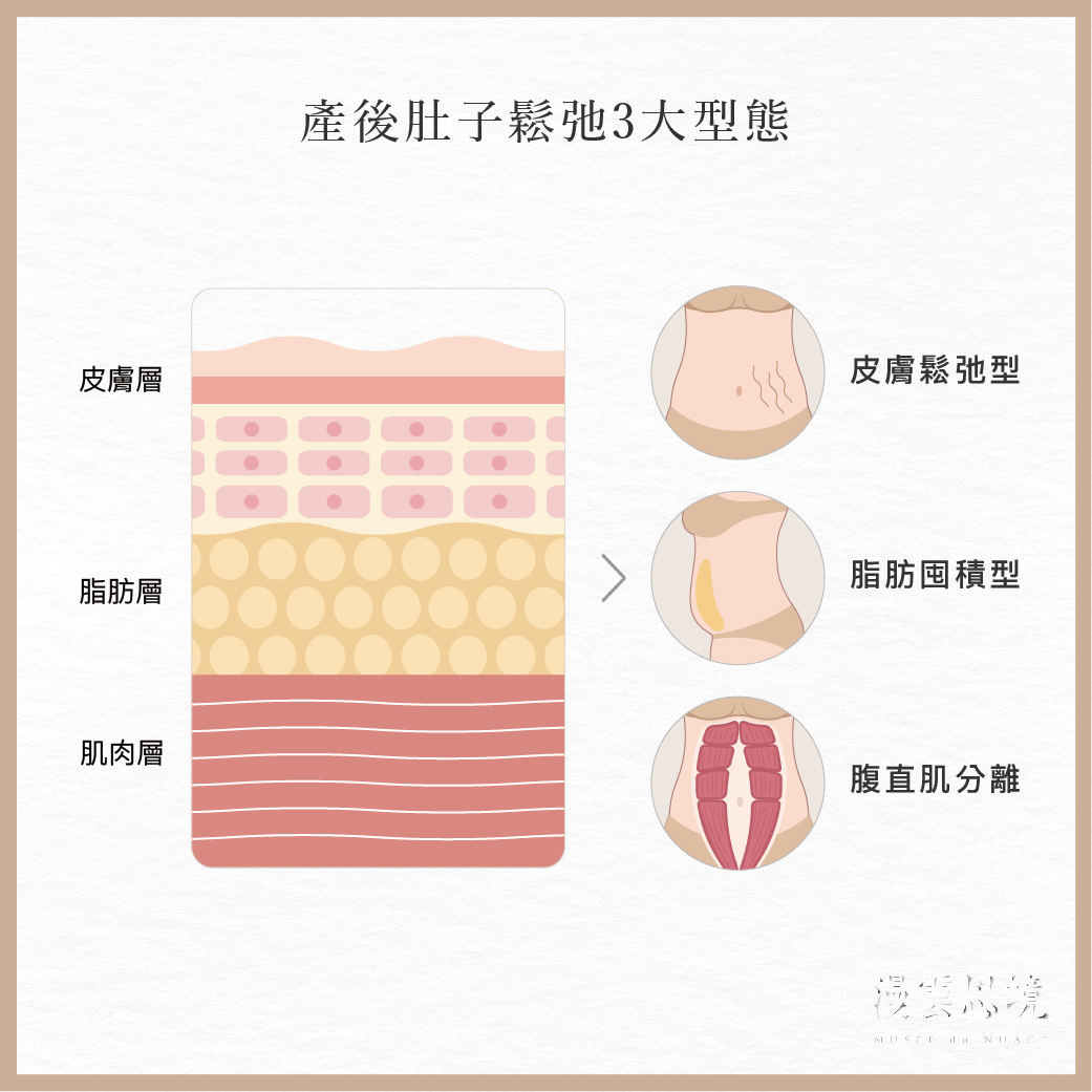 產後肚皮鬆垮原因解析