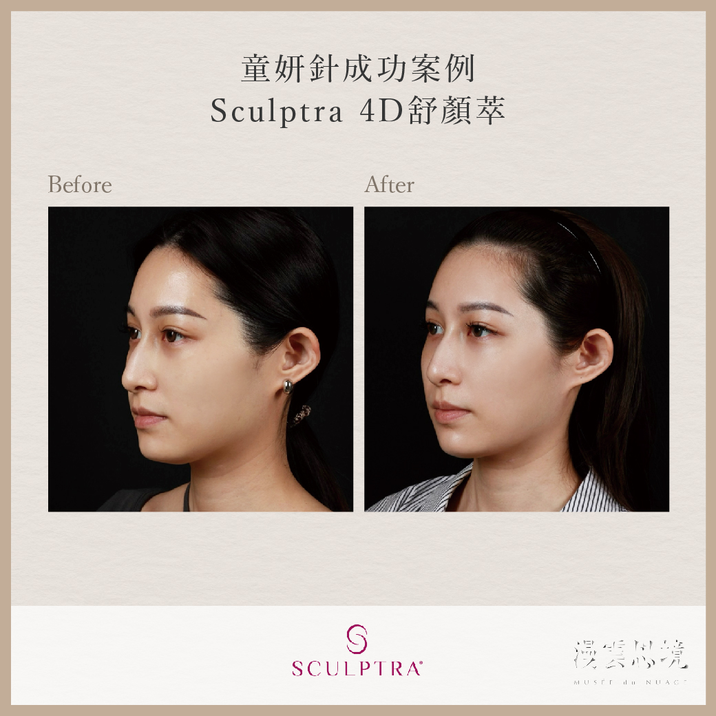 Sculptra 4D舒顏萃 童妍針成功案例