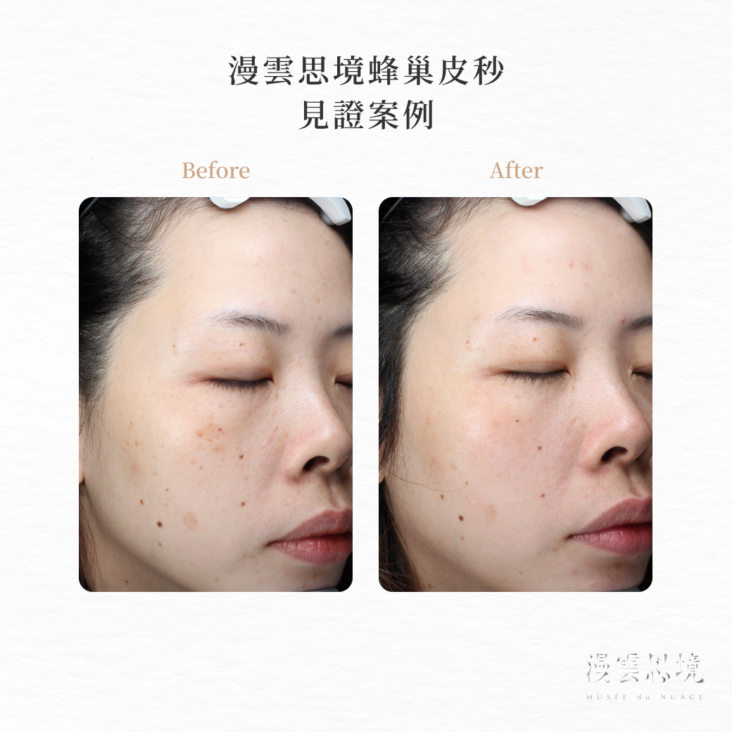 蜂巢皮秒術前術後對照圖