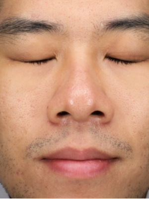 染料+UP 合併治療後