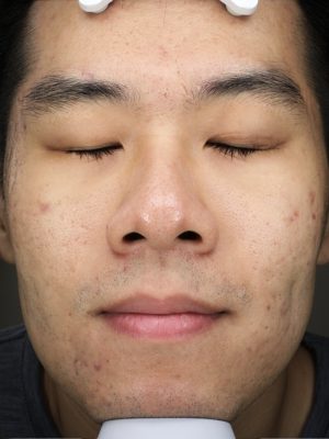 染料雷射 up雷射 術前 效果 張德力