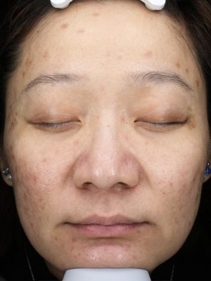 染料雷射 up雷射 術前 效果 徐琁珮