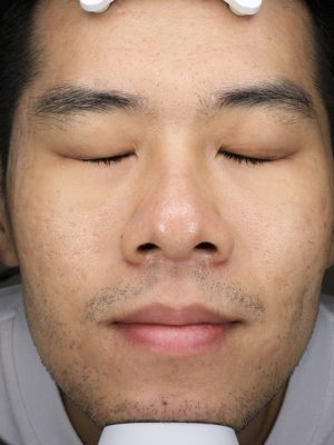 染料雷射 up雷射 術後 效果 張德力