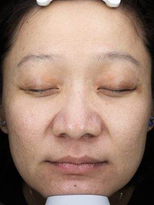 染料雷射 up雷射 術後 效果 徐琁珮